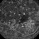 Choroidal Infarcts Post Preeclampsia Choroidal Infarcts Post Preeclampsia
